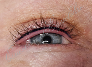 Maquillage permanent intralash